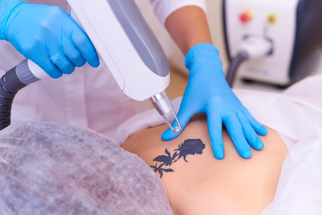 tattoo removal perth